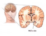 Mối liên quan giữa chứng u não và bệnh động kinh