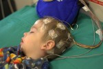 Vì sao trẻ mắc hội chứng Sturge Weber thường bị động kinh không kiểm soát