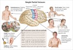 4 khu vực não bị ảnh hưởng gây ra bệnh động kinh cục bộ