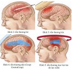 Di chứng động kinh sau chấn thương sọ não